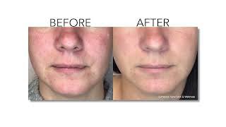 Lumecca - Intense Pulsed Light ( IPL) for face /neck; Regional Eye Center; Americus Georgia