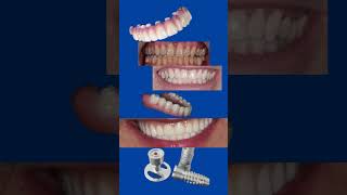 SOLUCIONES CON IMPLANTES DENTALES