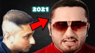 YO YO Honey Singh Latest|Hair Transplant|Hair patch|minoxidil|finasteride|results|hindi|hairstyle