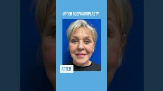 Before and after Facelift, Deep Necklift, Upper Blepharoplasty💖