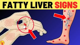 10 Warning Signs of Fatty Liver Disease You Should Never Ignore | VisitJoy