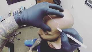 Scalp Micropigmentation POV GoPro