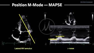 〖Echocardiography〗 MAPSE - left ventricular function with M-Mode