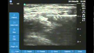 Ultrasound Guided Femoral nerve block