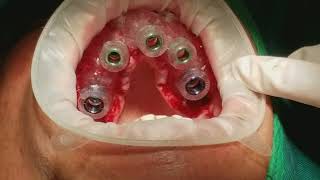 Serial extraction of maxillary dentition w/ immediate implant placement