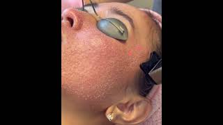 essentialaestheticsandlaser full face ch 2laser resurfacing treatment#wrinkles#texture#acnescarring#