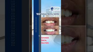 How we treat Discolored Front tooth? | Quick SMILE TRANSFORMATION |Thanjai Dental