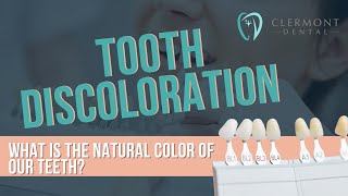 Tooth Discoloration: What is the Natural Color of Our Teeth? #ToothDiscoloration #DentalHealth