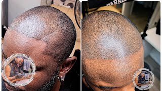 Scalp micro pigmentation hair tattoo for people with bald hair ❤️🤝