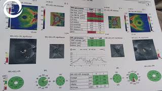 Ophthalmic Signs OCT