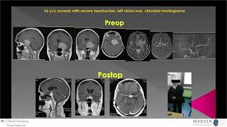 Anterior Clinoid Meningiomas | MASSIN Congress Day 1 | Session 1, Talk 3