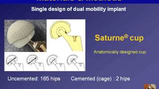 Prevention of instability with the use of a dual mobility implant for primary hip arthroplasty