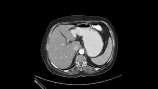 Upper Abdomen CT