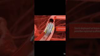 how stent is placed in heart? #shorts#viral#shortvideo#youtubeshorts#viralvideo