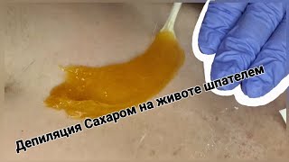 Удаление Волос Сахаром. Депиляция на животе.