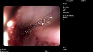 Esophageal tear with massive haematemisis after blunt injury chest controlled by banding.