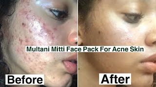 Remove Pimples,Acne And Dark Spots Instantly|Multani Mitti Face Pack|Glam By Humail