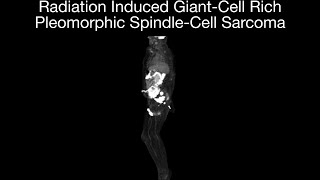 Radiation induced Giant-cell rich pleomorphic spindle cell sarcoma