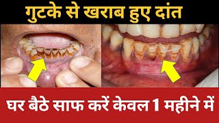 गुटके और पान के दाग घर बैठे साफ करें। teeth cleaning | teeth whitening | teeth whitening at home