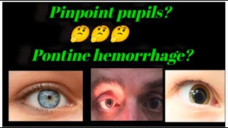 pupil indicate us which area of brain has hemorrhagic stroke