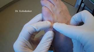 Shaving of a callous or corn done in the office Orange County - Irvine - Newport - HB - Orange