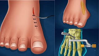 The big finger of the foot is crooked and will fix it by doing surgery #mrnajeebideas