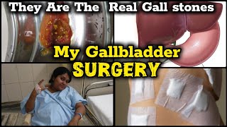 I Removed My Gallbladder And Here Is What Happened  Next 😭😔