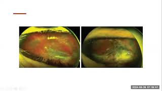 Vitreorretinopatía Proliferativa (VRP)