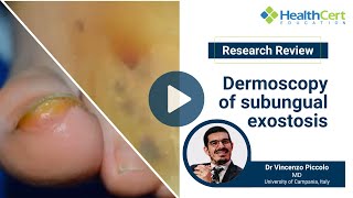 Dermoscopy of subungual exostosis | Dr Vincenzo Piccolo