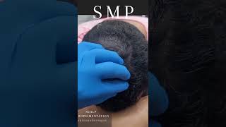 RESTORE YOUR CONFIDENCE AND YOUR HAIRLINE with SCALP MICROPIGMENTATION (SMP) By Antonio Baroqur