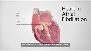 Il cuore durante la Fibrillazione Atriale