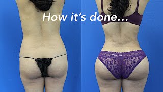 Brazilian Butt Lift Beverly Hills Doctor Shows How It's Done