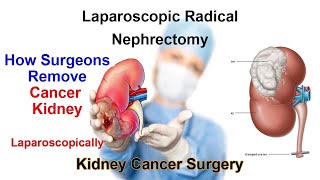 Laparoscopic Left Radical Nephrectomy (Kidney Cancer Surgery) Renal Cell Carcinoma - Unedited Video