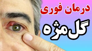 درمان گل مژه | درمان خانگی گل مژه و کنترل عفونت و ورم پلک فقط در یک هفته