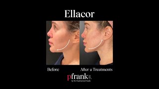 Patient Shares Amazing Experience and Excitement After a Simple and Painless Ellacor Treatment