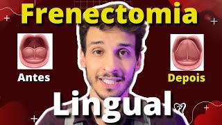 Frenectomia Lingual: A Solução para Desafios na Fala e na Alimentação