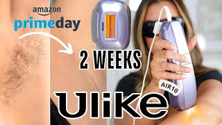 I Tried NEW Ulike Air10 IPL Hair Removal at Home (Before/After Results)