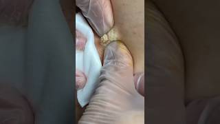 Blackheads Big