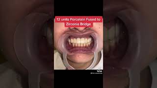 12 units of Porcelain Fused to Zirconia Bridge | DR MAE ABELLA