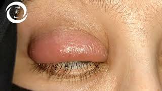 Ophthalmic Signs Eyelids