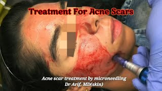 Dermaroller( microneedling)for acne scars  @DrArifMDDermatologist#acnescars #acnetreatment #prpfacial