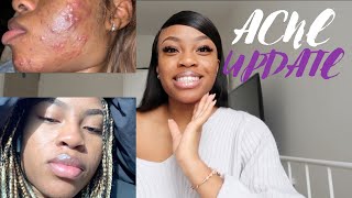 SKINCARE SATURDAYS | HOW I CLEARED 6 YEARS OF ACNE IN 3 MONTHS!!! | FT MDacne