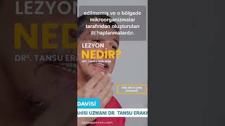 Kapıdaki Tehlike: Dişte Lezyon Nedir? Nasıl Fark Edilir? Tehlikeli Midir?