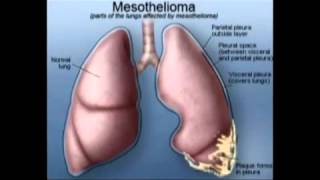 What Is Mesothelioma | Mesothelioma Resources Insurance