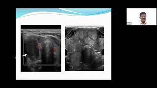 Faculty Lecture by Prof  M. L.  Saha on Quadruple Assessment of Thyroid (28.01.23)