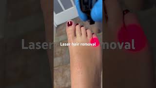 Laser hair removal on feet of female