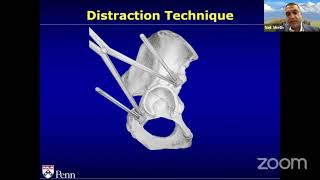 Update in the Management of Acetabular Defects