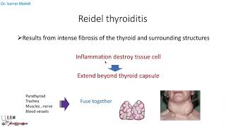 16 Thyroiditis part 3  Lymphocytic , Reidel