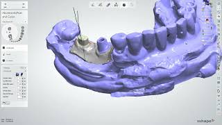 Implant Abutment Design with 3Shape