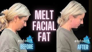 Double Chin Removal with Endolift 💕 How To Get Rid of Double Chin Effectively